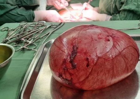 توده چهار کیلوگرمی از بدن دختر اسفراینی خارج شد